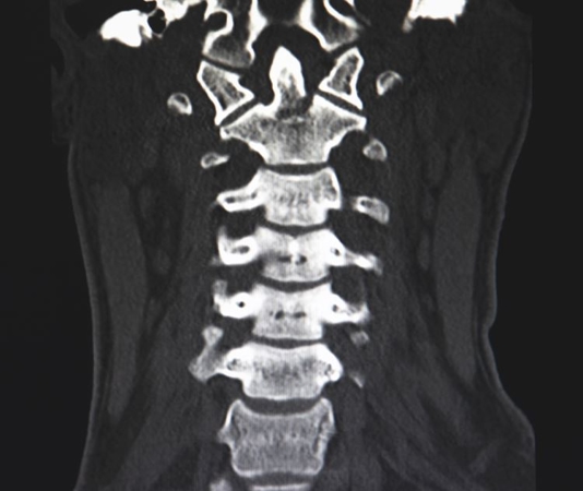 Whiplash Is Associated With Depression And PTSD