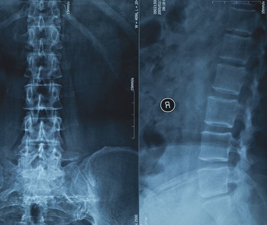 Beyond Paralysis: The Wide-ranging Consequences of Spinal Injuries