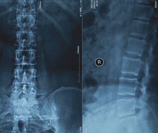 Spinal Cord Injury Is Associated With Increased Risk For Common Cardiovascular Disease