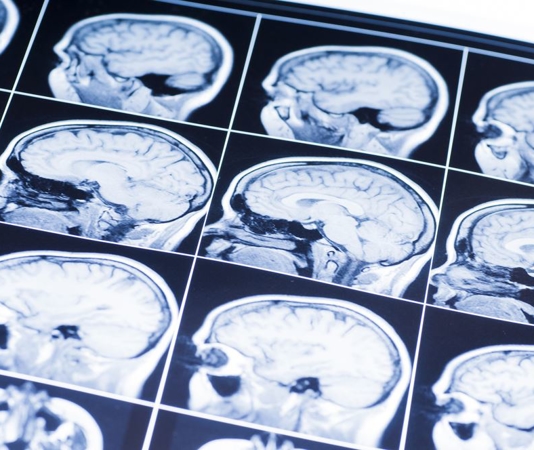 How Serious is a Traumatic Brain Injury in Los Angeles?
